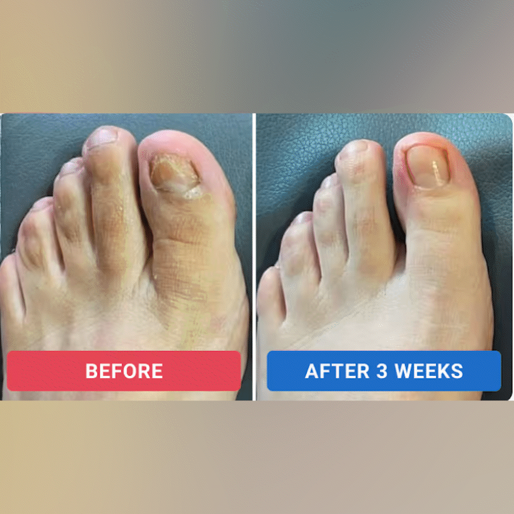 【Official Flagship Store】🎁 Buy 1 Get 1 Free - Fungal Nail Renewal Patches
