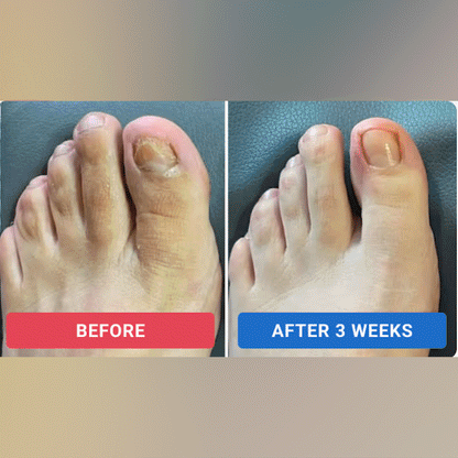 【Official Flagship Store】🎁 Buy 1 Get 1 Free - Fungal Nail Renewal Patches