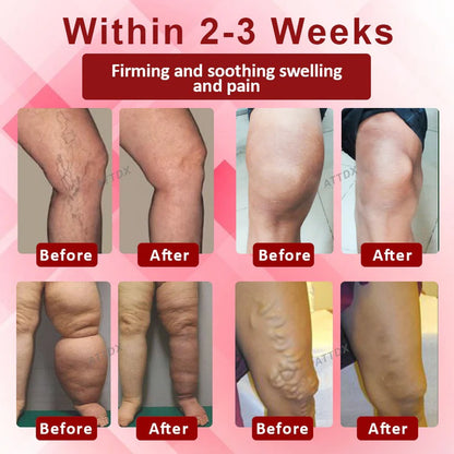 Boost Circulation and Relieve Swelling 🚶‍♀️💨