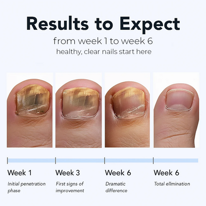 【Official Flagship Store】🎁 Buy 1 Get 1 Free - Fungal Nail Renewal Patches